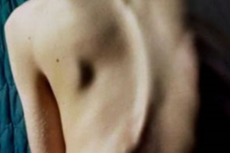 强直性脊柱炎脊柱扭曲图