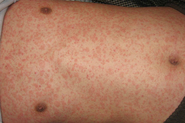 喝酒过敏红疹图