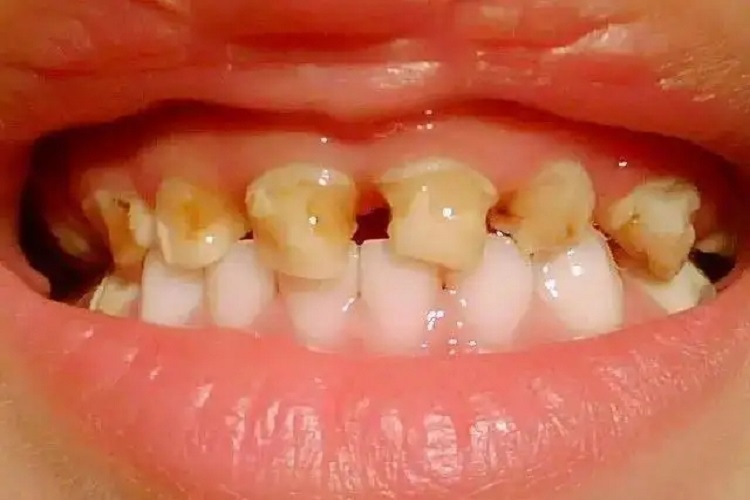 牙釉质发育不全图