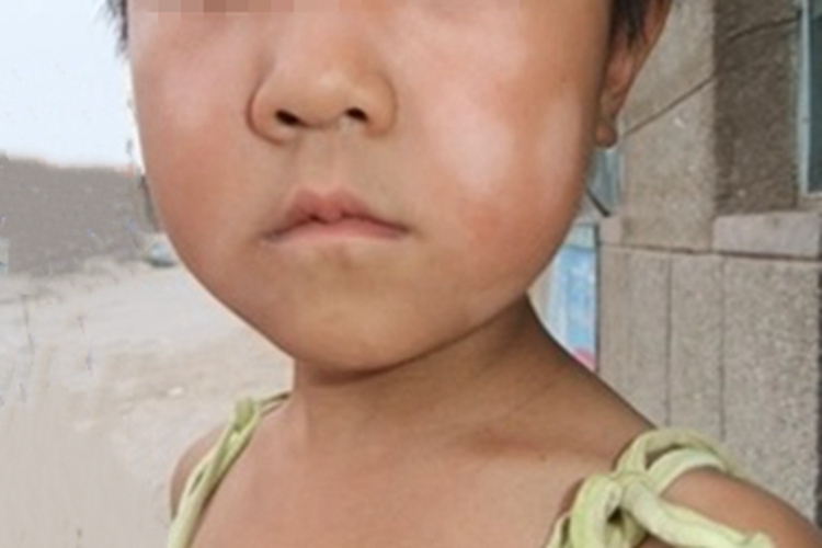 花斑糠疹脸好几处白斑图 花斑糠疹脸好几处白斑图