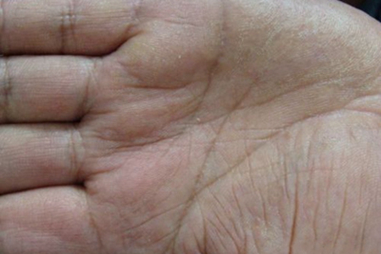 砷角化病手掌皮肤发黄图