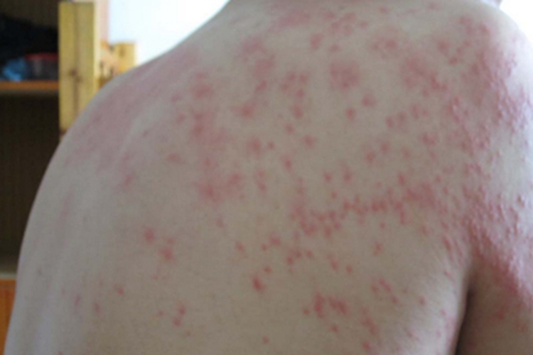 感染性荨麻疹背部小红疙瘩图 感染性荨麻疹背部小红疙瘩图