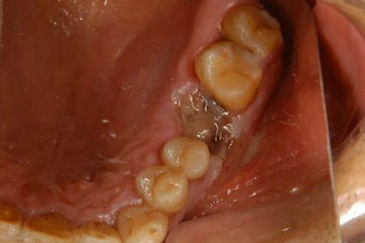 干槽症牙洞灰白色伪膜图