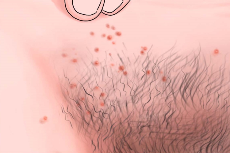 阴茎根部毛囊炎手绘图