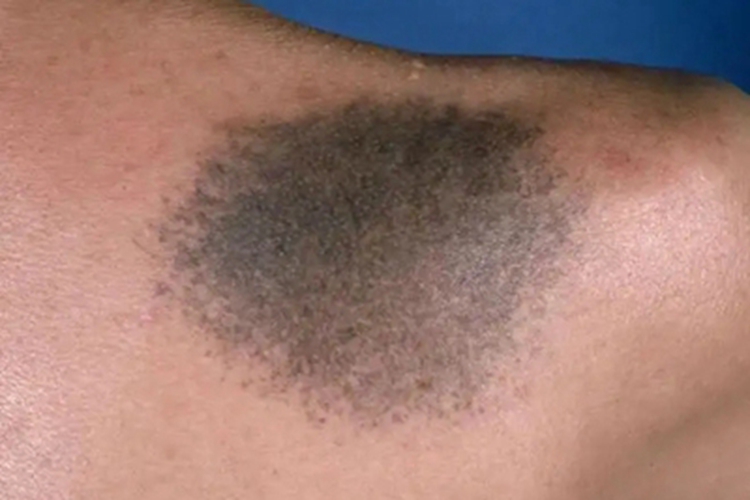 色素型胎记肩部黑斑图