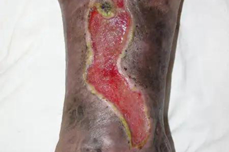 下肢深静脉血栓形成溃疡图 下肢深静脉血栓形成溃疡图