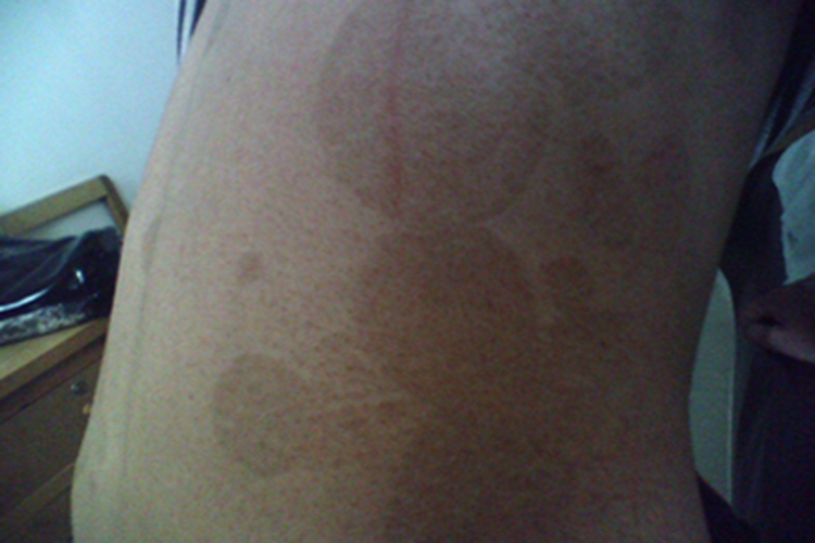 连圈状秕糠疹背部斑图