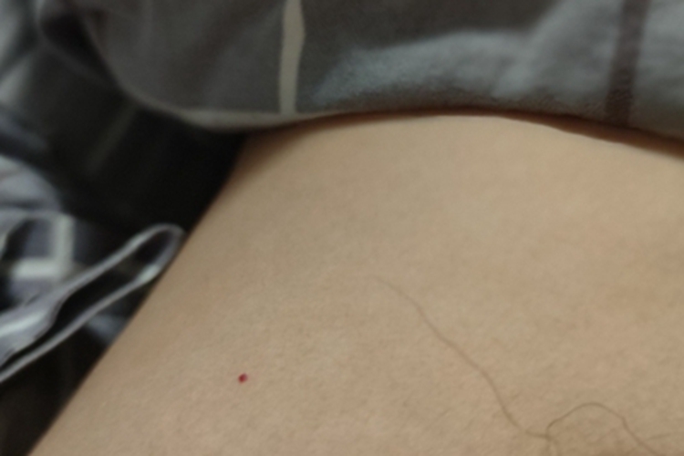 毛细血管瘤腹部有红色点点图 毛细血管瘤腹部有红色点点图