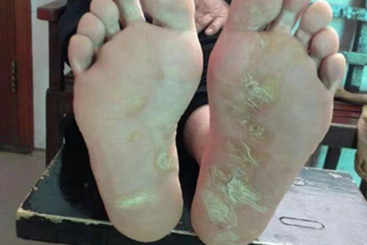 获得性掌跖角化病脚底皮肤增厚图