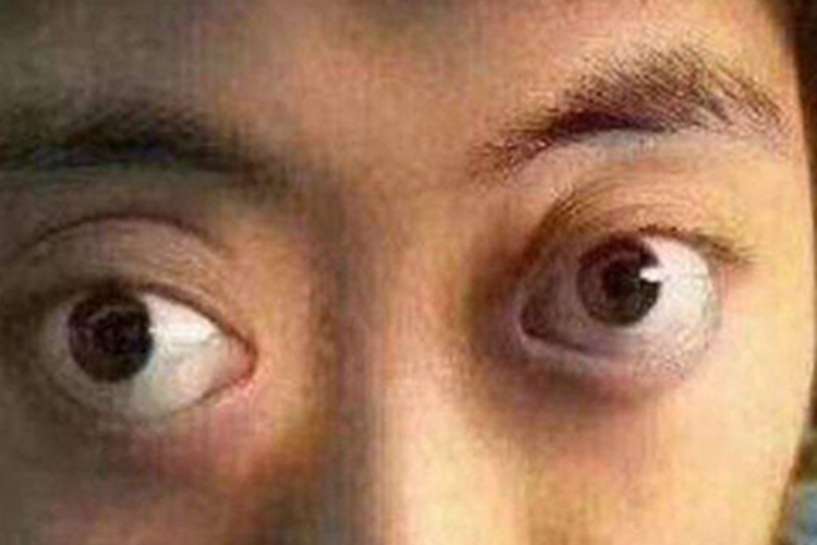 眼眶畸胎瘤症状图 眼眶畸胎瘤症状图