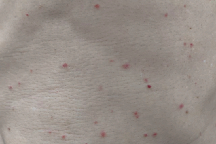 寻常型银屑病腹部很多结节图