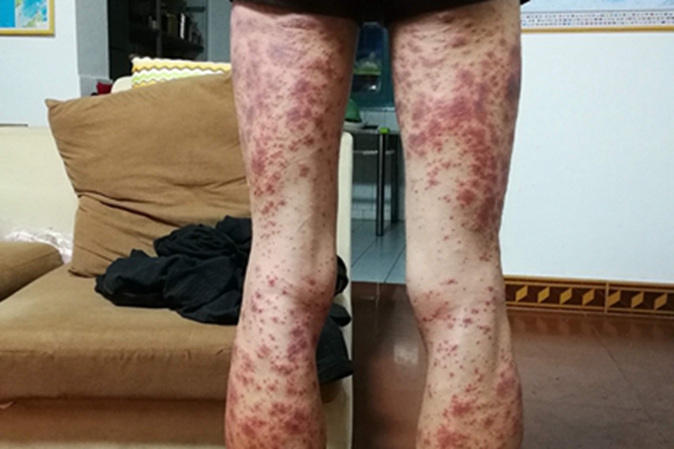 糖皮质激素性紫癜下肢有瘀斑图 糖皮质激素性紫癜下肢有瘀斑图