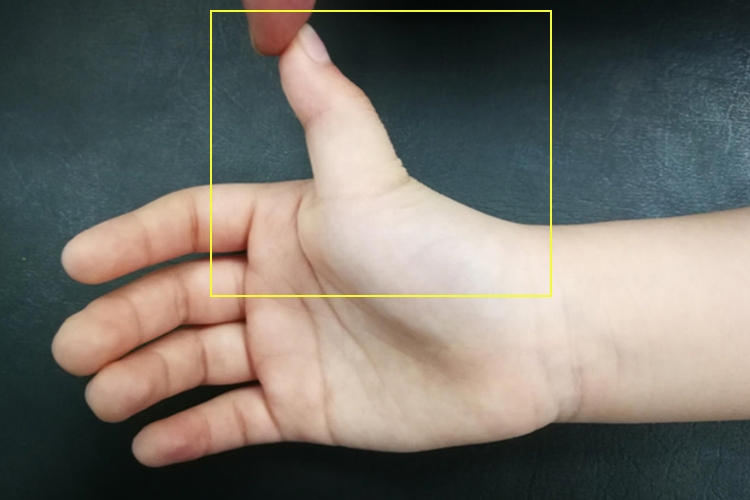 拇指背伸图 拇指背伸图