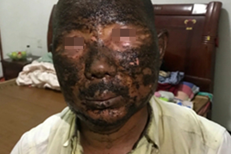 电弧烧伤面部黑痂图 电弧烧伤面部黑痂图