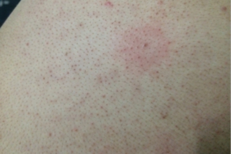 铜绿假单胞菌毛囊炎红斑图 铜绿假单胞菌毛囊炎红斑图