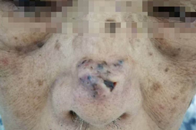 结节型基底细胞瘤鼻尖疙瘩小坑图