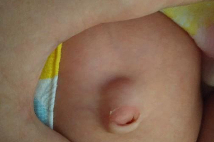 小儿脐疝肚脐长肿块图 小儿脐疝肚脐长肿块图