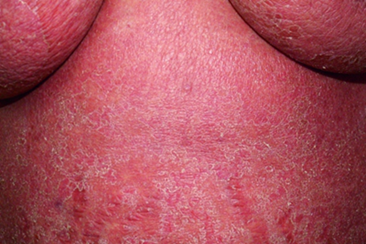 剥脱性皮炎型药疹腹部症状图 剥脱性皮炎型药疹腹部症状图