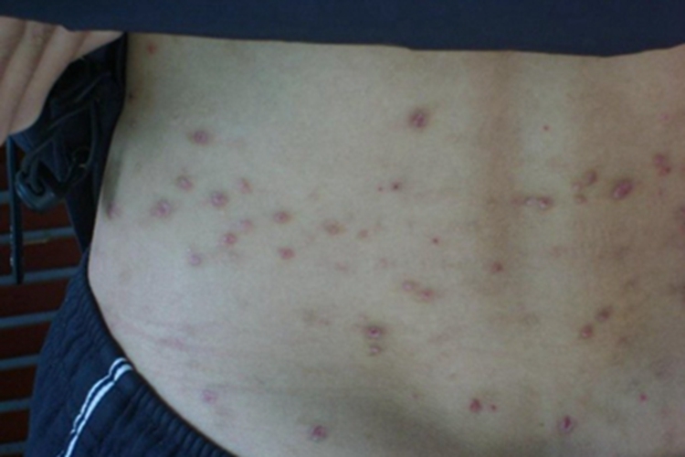 结节性痒疹后腰部有散在疹子图