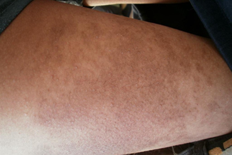 泛发型表皮痣大腿有小疙瘩图 泛发型表皮痣大腿有小疙瘩图