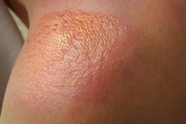 职业性光变应性接触性皮炎肩部小水疱图