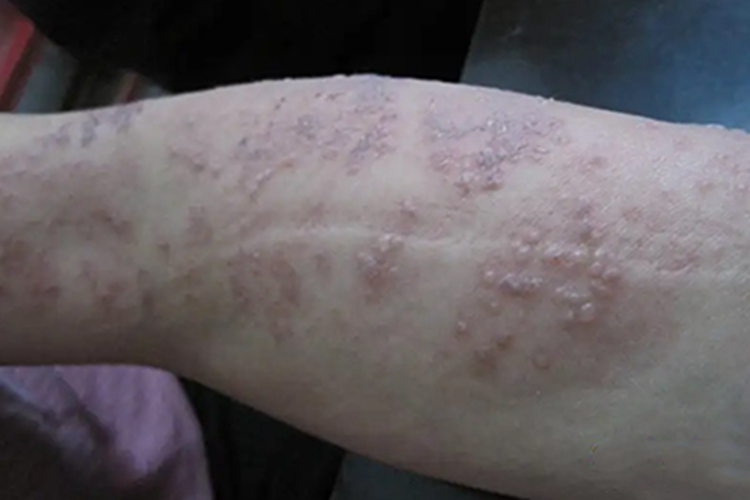手臂内测长带状疱疹图