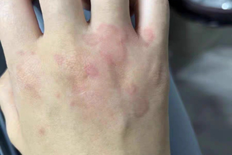 慢性自发性荨麻疹手局部红肿图