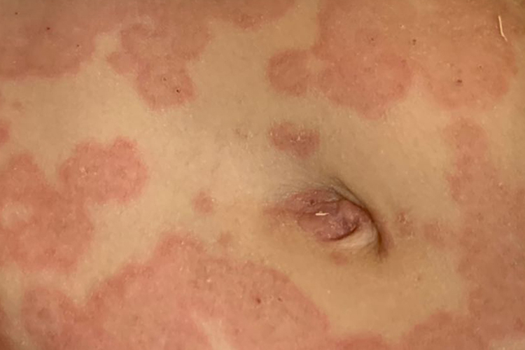 胸下面多形红斑图