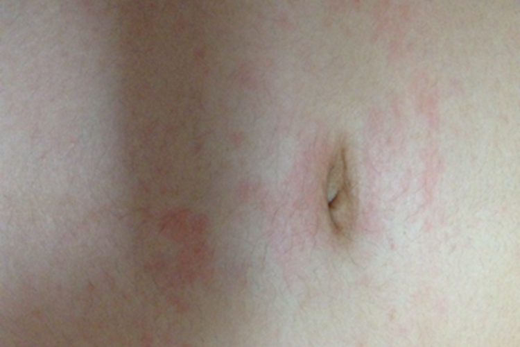 革螨皮炎中腹红斑图