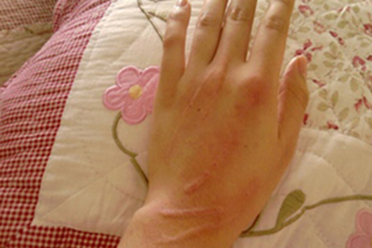 猫抓病手背症状图