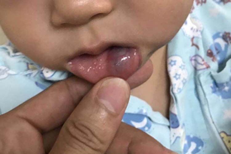 海绵状血管瘤唇内侧症状图