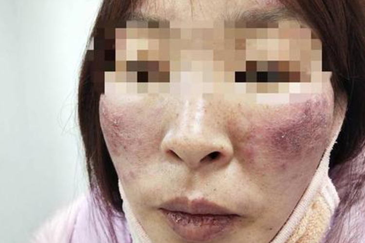 面部冻疮样红斑狼疮图