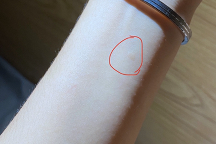 扁平疣胳膊疙瘩图