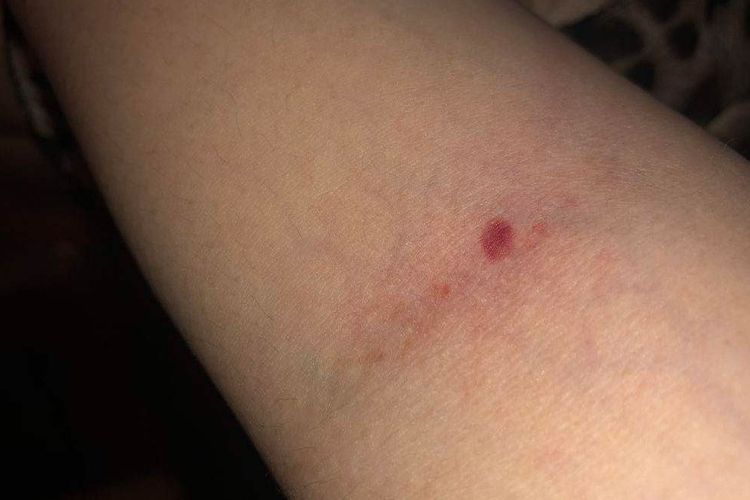 樱桃状血管瘤图