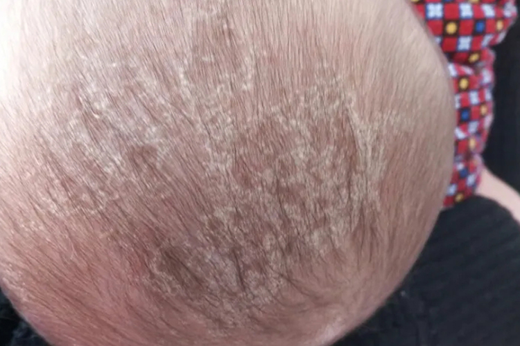 慢性湿疹头顶大块头皮屑结痂图