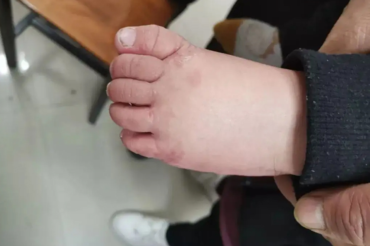 小儿鳞屑角化型脚癣