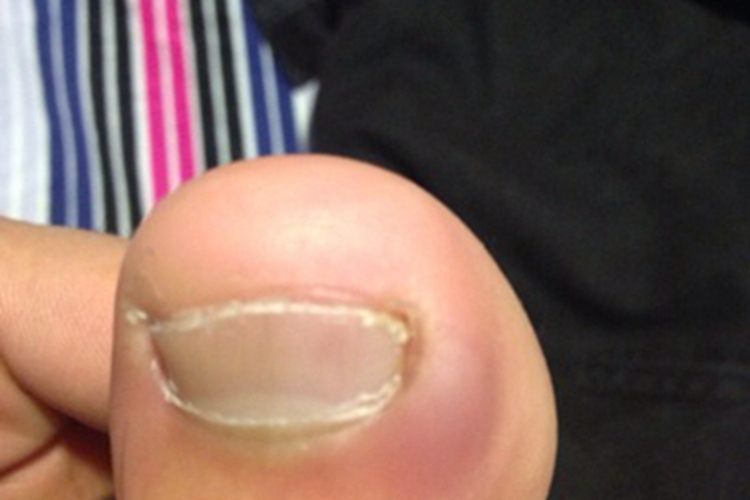 甲床炎大拇脚趾一侧红肿图