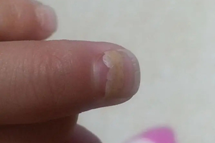 甲营养不良甲分层图