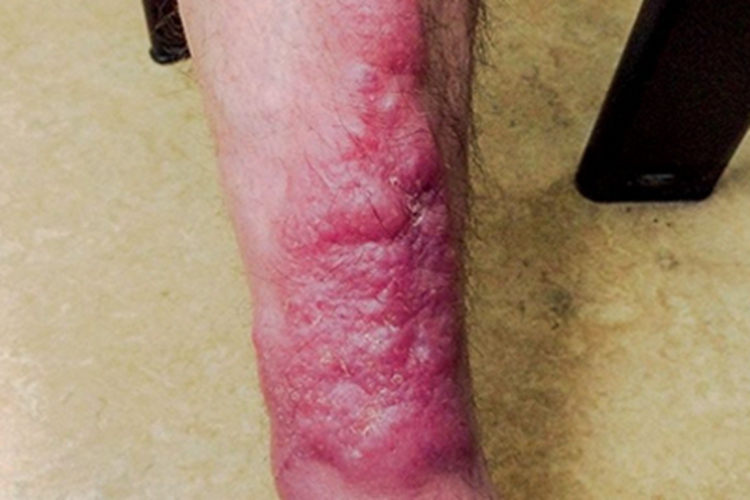 胫前黏液性水肿小腿上红色结节图