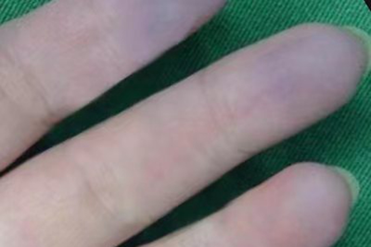 雷诺病手指尖皮肤发紫图 雷诺病手指尖皮肤发紫图