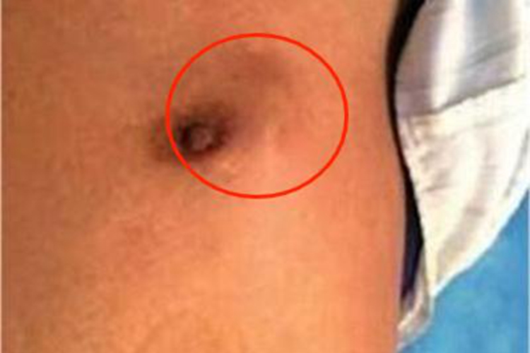 男性乳腺癌乳房包块图