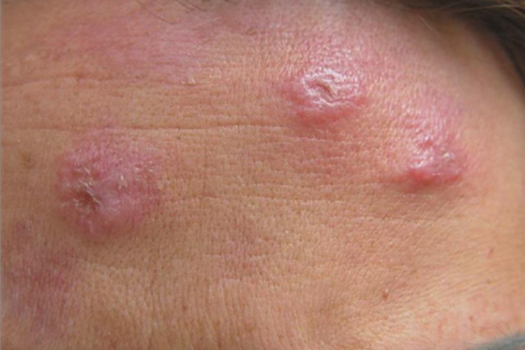 持久隆起性红斑前额症状图