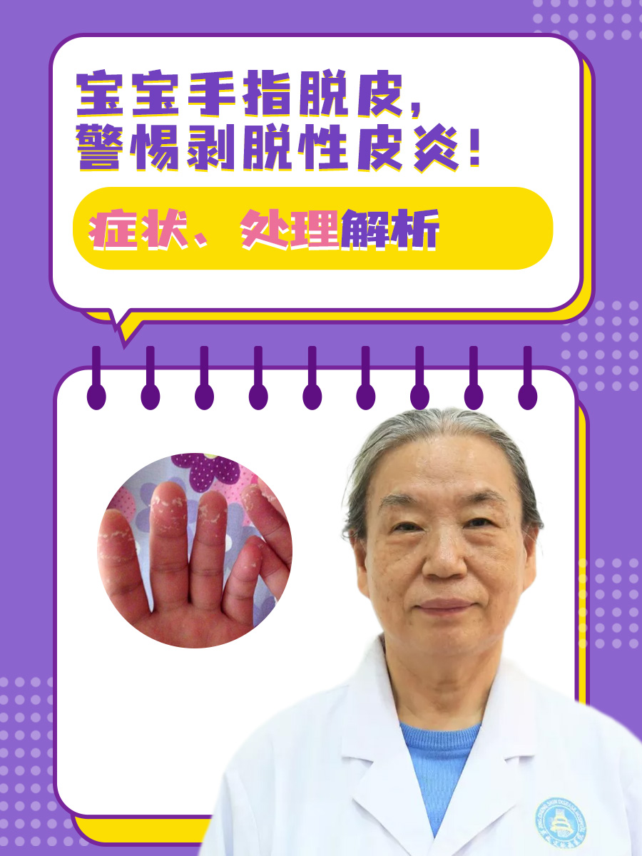 宝宝手指脱皮，警惕剥脱性皮炎！症状、处理解析
