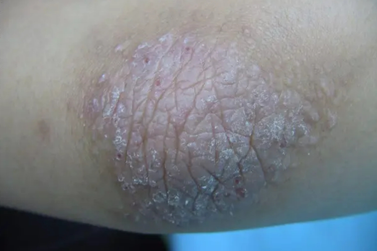 胳膊肘神经性皮炎图