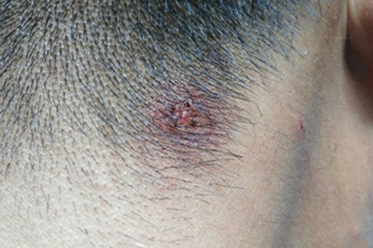 毛发肉芽肿头部结痂图 毛发肉芽肿头部结痂图