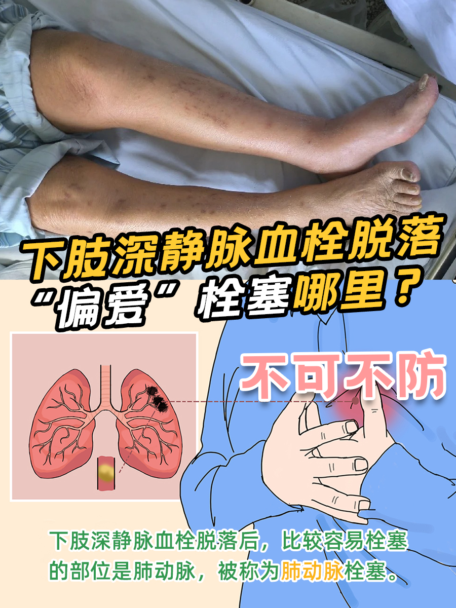 下肢深静脉血栓脱落“偏爱”栓塞哪里？不可不防