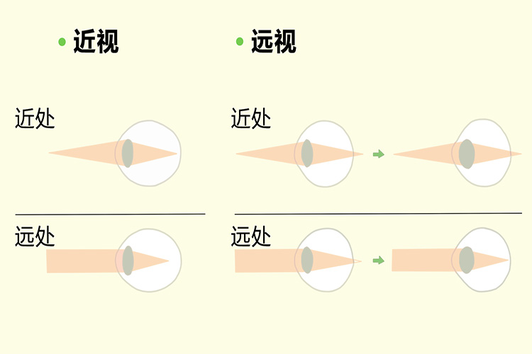 近视眼和远视眼示意图