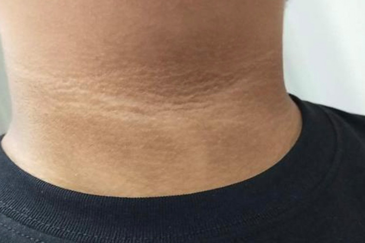 皮肤皱褶部位黑棘皮病图 皮肤皱褶部位黑棘皮病图