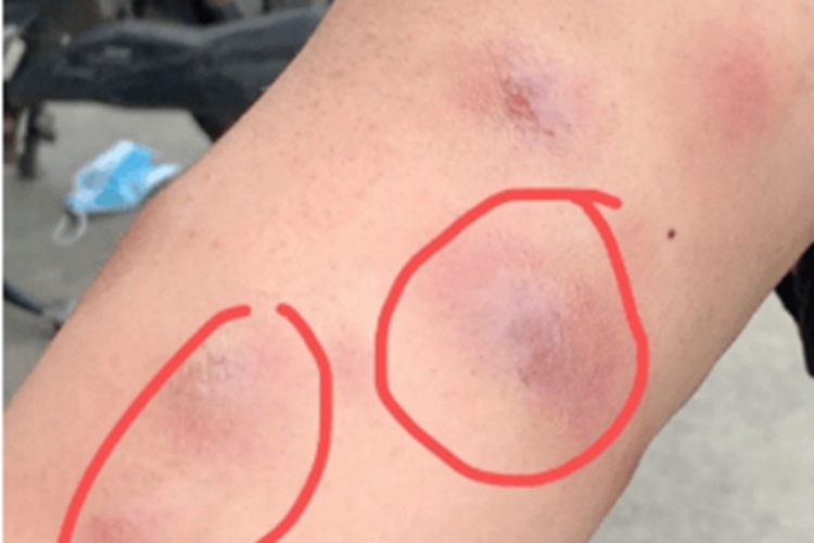 偶遇分枝杆菌感染大腿凹凸不平图