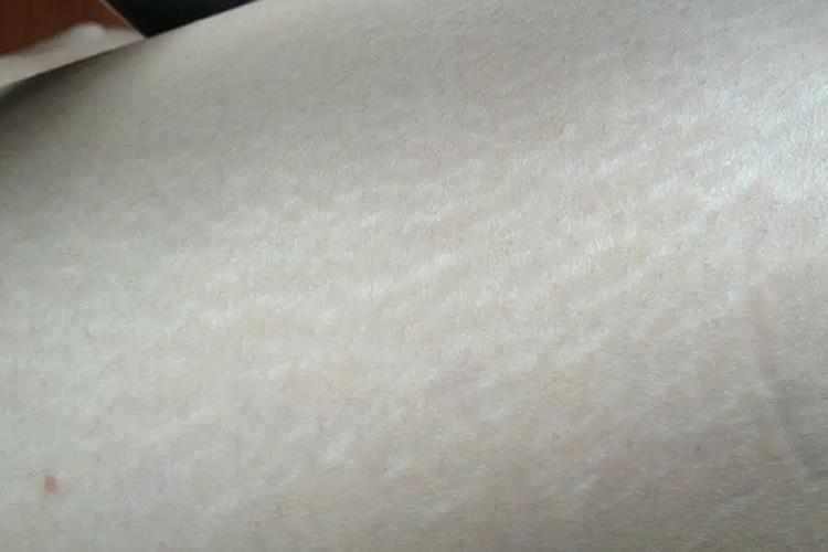 膨胀纹大腿上有白痕图